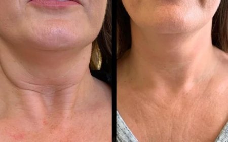 Reinvent Skin with Profhilo by Best Doctors in dubai