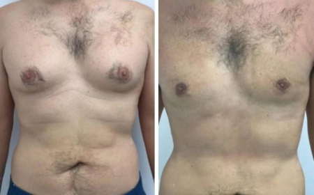 The Importance of Finding the Best Gynecomastia Surgeon in dubai for Your Personal Needs