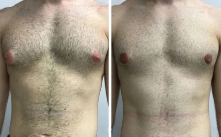 Why Patients Trust the Best Gynecomastia Surgeon in Dubai for Male Breast Reduction