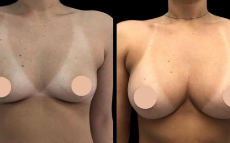Natural Results from the Best Breast Augmentation Surgeon in Dubai