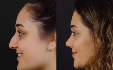 Healing Starts with the Best Septoplasty Surgeons in Dubai