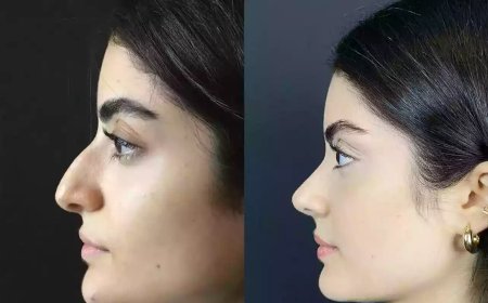 Best Rhinoplasty Surgeons in Dubai with Decades of Proven Results