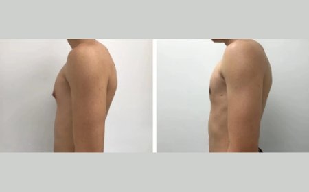 What to Expect from the Best Gynecomastia Surgeons in Dubai