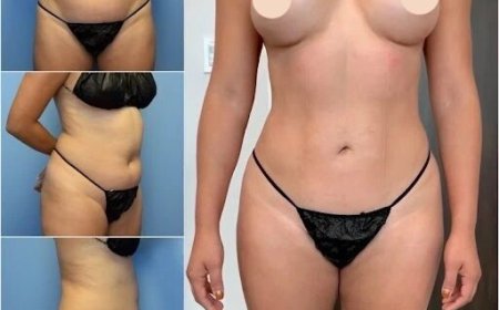Top Reasons to Choose the Best Body Contouring Surgeons in dubai for Your Body Goals