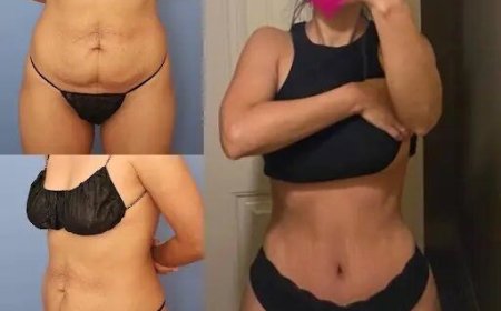 What Makes the Best Tummy Tuck Surgeons in dubai So Highly Regarded by Patients?