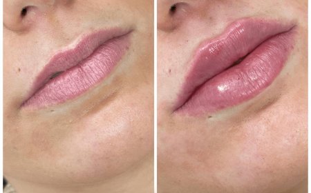 How to Choose the Right Juvederm Treatment for Your Needs: Expert Tips from the Best Plastic Surgeon in Dubai