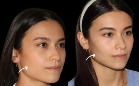 Best Doctors in Dubai on Preventative Aging: Sculptra Fillers in Your 30s